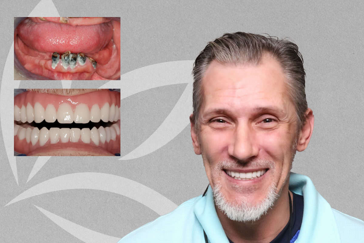 Complete Upper & Lower Denture featured transformation
