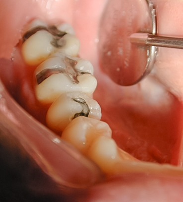 Before Composite Fillings