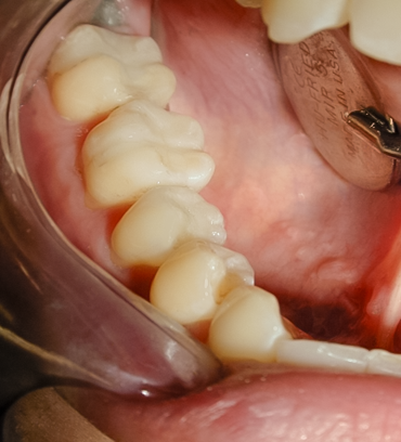 After Composite Fillings