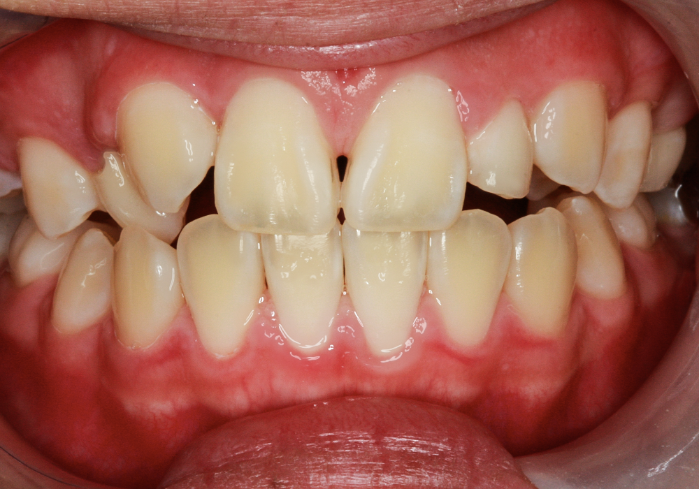 Before Alyssa, Custom Crowns for a Balanced and Beautiful Smile