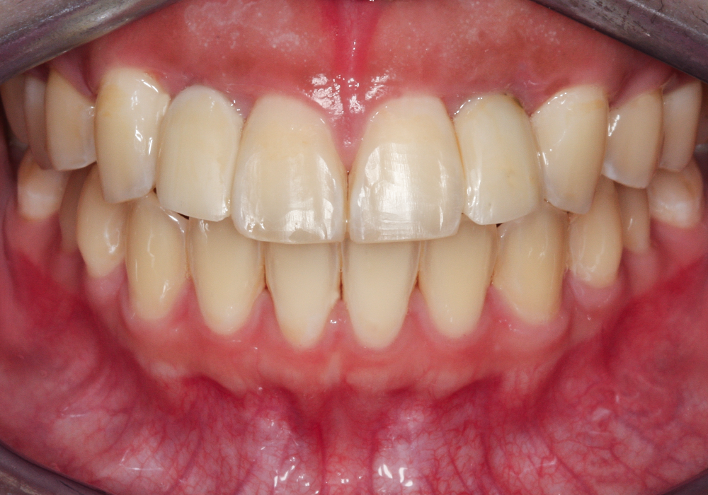 After Alyssa, Custom Crowns for a Balanced and Beautiful Smile