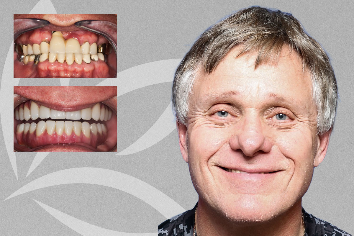 Teeth in a Day Full Upper. Lower All on 4, Darrell