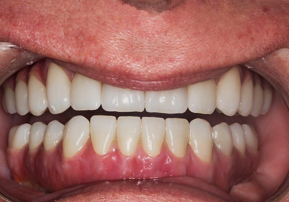 After Teeth in a Day Full Upper. Lower All on 4, Darrell