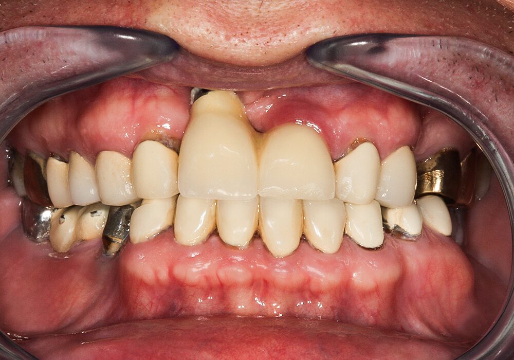 Before Teeth in a Day Full Upper. Lower All on 4, Darrell
