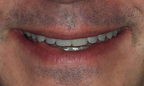 Invisalign®, David