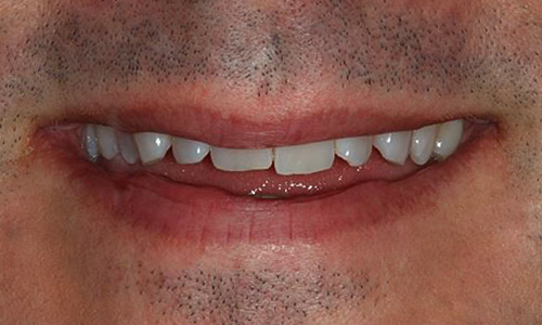 Before Invisalign®, David