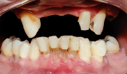 Before upper and lower denture treatment