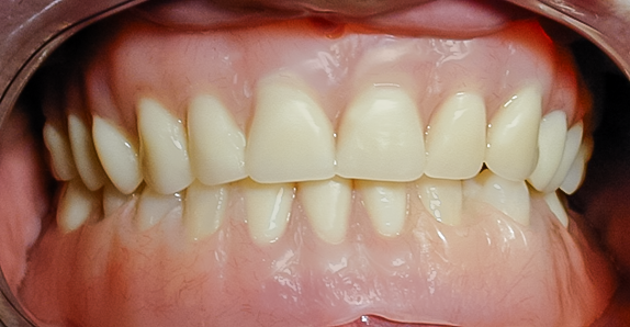 After upper and lower denture treatment