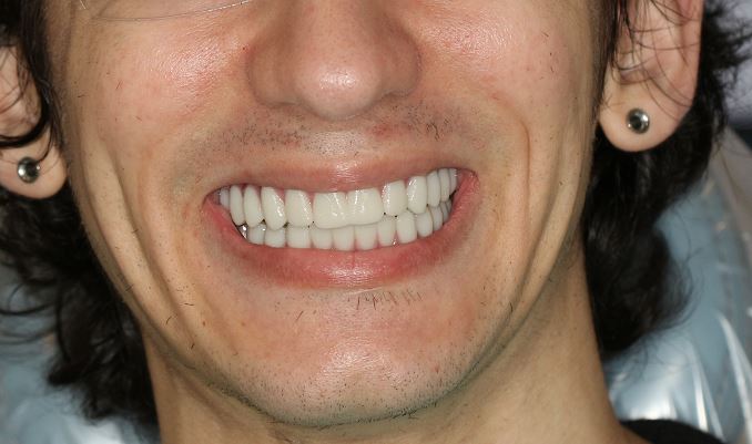 After Teeth in a Day | All on 6 Full Upper & Lower, Dillon