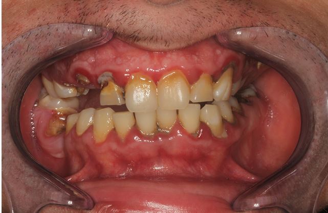 Before Teeth in a Day | All on 6 Full Upper & Lower, Dillon