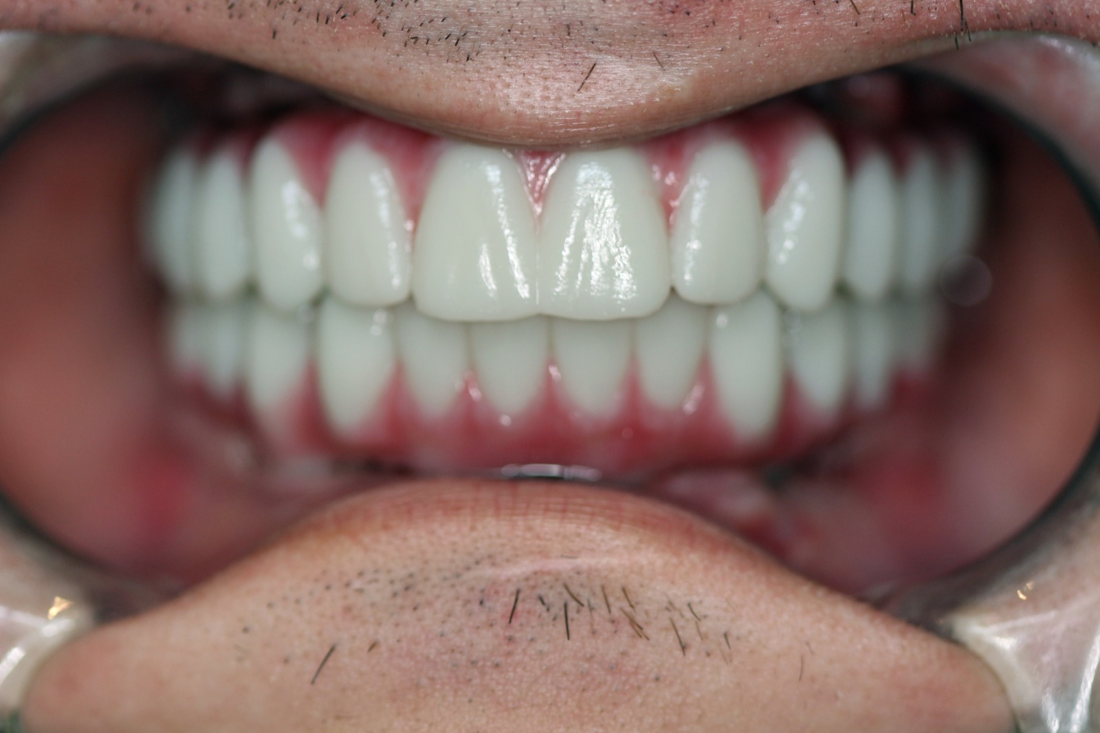 Close-up of Dillon's completed Teeth in a Day smile