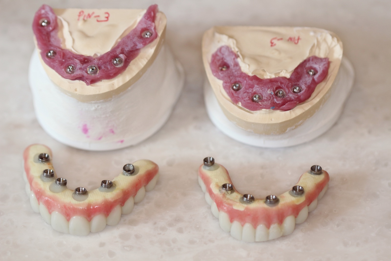 Dillon's Teeth in a Day prosthetics before placement