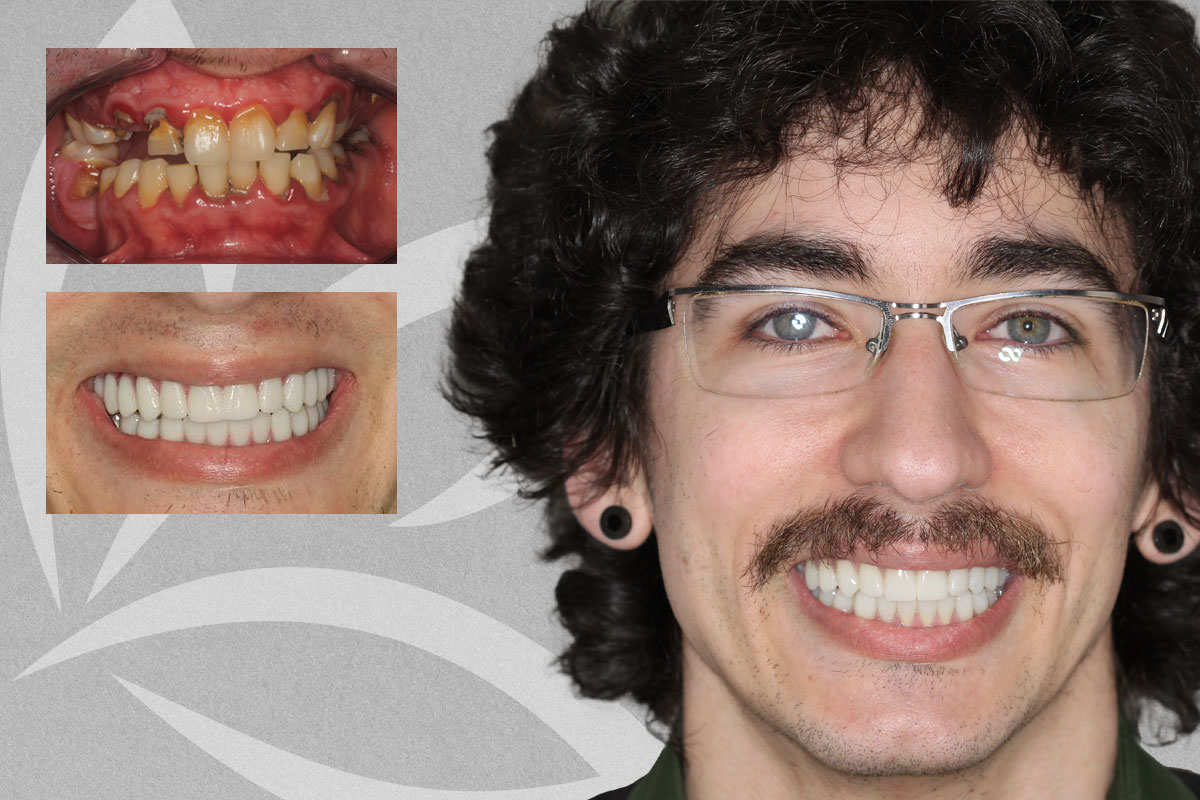 Teeth in a Day | All on 6 Full Upper & Lower, Dillon