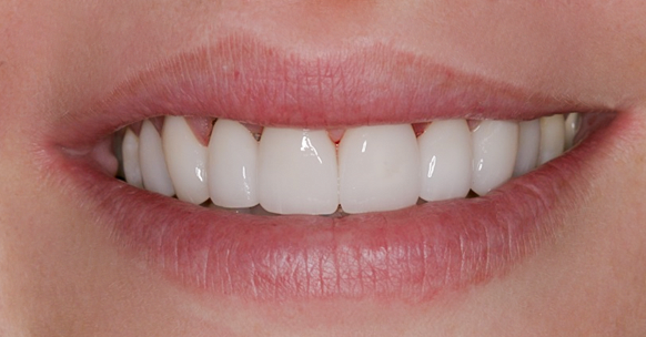 Eight Upper Veneers, for Crooked Teeth