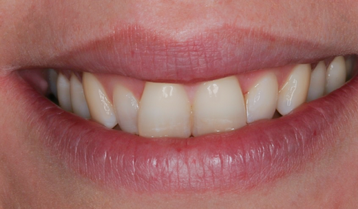 Before Eight Upper Veneers, for Crooked Teeth
