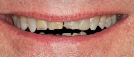 Before Eight Upper Veneers for Discolored and Uneven Teeth, A Brighter, More Even Smile