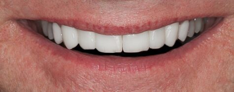Eight Upper Veneers for Discolored and Uneven Teeth, A Brighter, More Even Smile