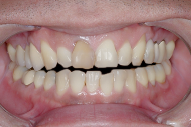 Before Eight Upper Veneers, for Discolored Front Teeth