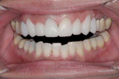 After Eight Upper Veneers, for Discolored Front Teeth
