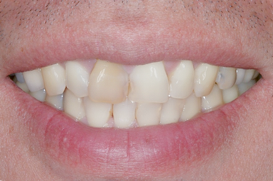 Before detail, Eight Upper Veneers, for Discolored Front Teeth