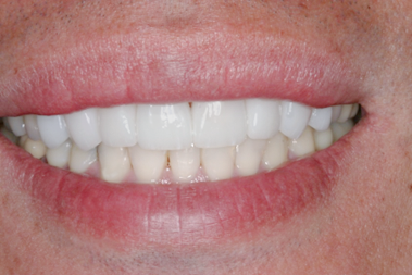 After detail, Eight Upper Veneers, for Discolored Front Teeth