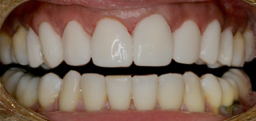 After Eight Upper Veneers, to Close Gaps & Lenghten Bicuspids