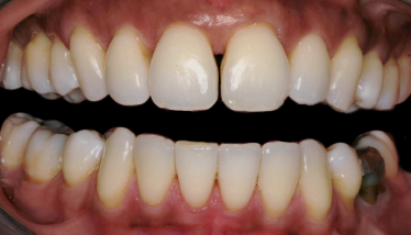 Before Eight Upper Veneers, to Close Gaps & Lenghten Bicuspids