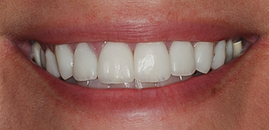 After Eight Upper Veneers Uneven Teeth, to Fix Chipped &