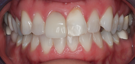 Before detail, Eight Upper Veneers Uneven Teeth, to Fix Chipped &