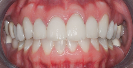 After detail, Eight Upper Veneers Uneven Teeth, to Fix Chipped &
