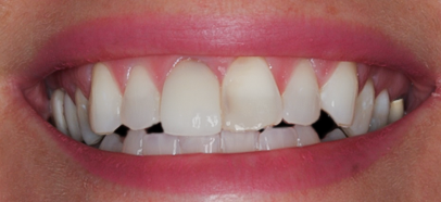 Before Eight Upper Veneers Uneven Teeth, to Fix Chipped &