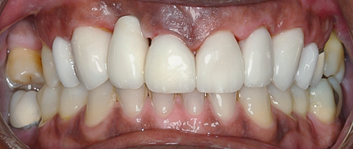 After Eight Upper Veneers, to Heighten Teeth