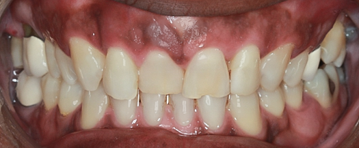Before Eight Upper Veneers, to Heighten Teeth