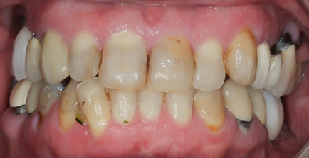 Before detail, Eighteen Veneers Full Mouth Rehabilitation for Crooked & Stained Teeth