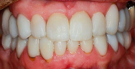 After detail, Eighteen Veneers Full Mouth Rehabilitation for Crooked & Stained Teeth