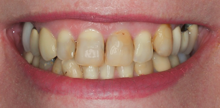 Before Eighteen Veneers Full Mouth Rehabilitation for Crooked & Stained Teeth