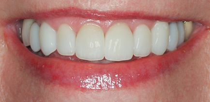 After Eighteen Veneers Full Mouth Rehabilitation for Crooked & Stained Teeth
