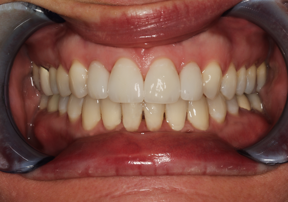 After Veneers & Crowns, Elizabeth