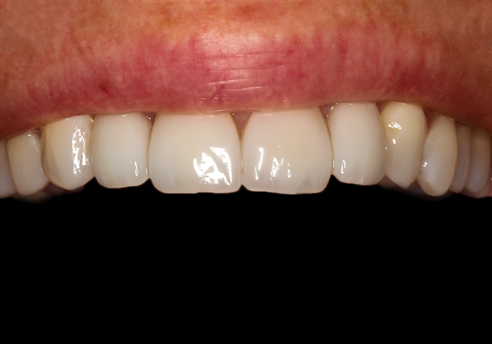 PowerPoint case photo, Veneers & Crowns, Elizabeth