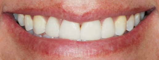 After Four Veneers, Emily