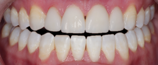 After detail, Four Veneers, Emily