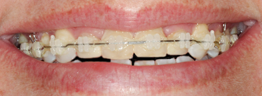 Before Four Veneers, Emily