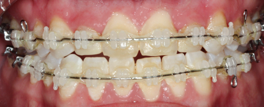 Before detail, Four Veneers, Emily