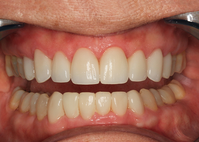 After Veneers & Crowns, Eve