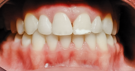 Before Fluorosis or White Spots