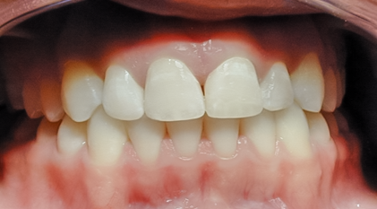 Fluorosis or White Spots