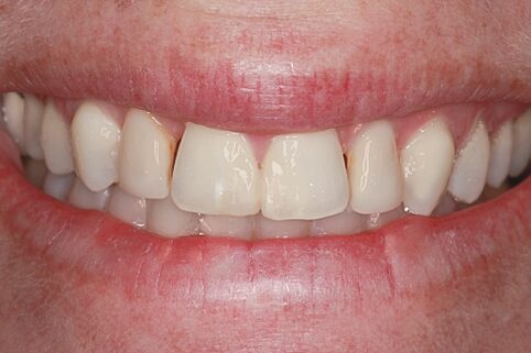 Before Four Upper Veneers, A Subtle Enhancement for a Confident Smile