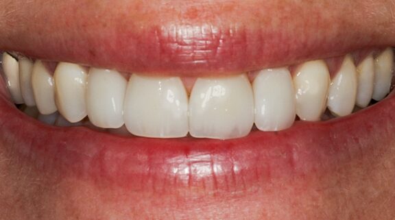 After Four Upper Veneers, A Subtle Enhancement for a Confident Smile
