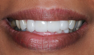 After Four Upper Veneers Three Lower Veneers, to Lengthen, for Overcrowding