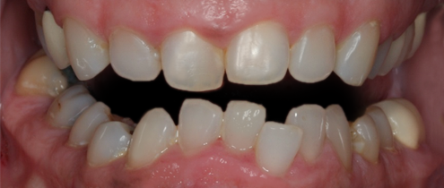 Before detail, Four Upper Veneers Three Lower Veneers, to Lengthen, for Overcrowding
